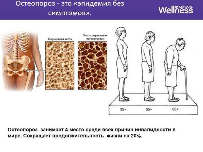 Остеопороз - это «эпидемия без симптомов».  Остеопороз  занимает 4 место среди всех